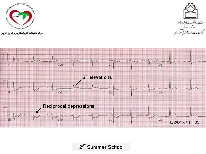 ST elevations Reciprocal depressions 2 st Summer School 