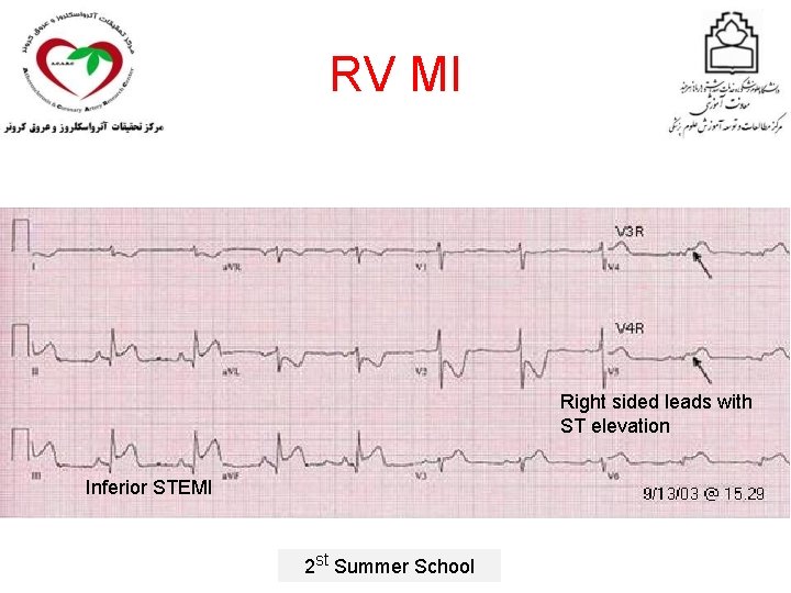 RV MI Right sided leads with ST elevation Inferior STEMI 2 st Summer School