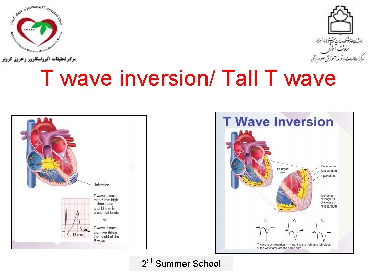 T wave inversion/ Tall T wave 2 st Summer School 