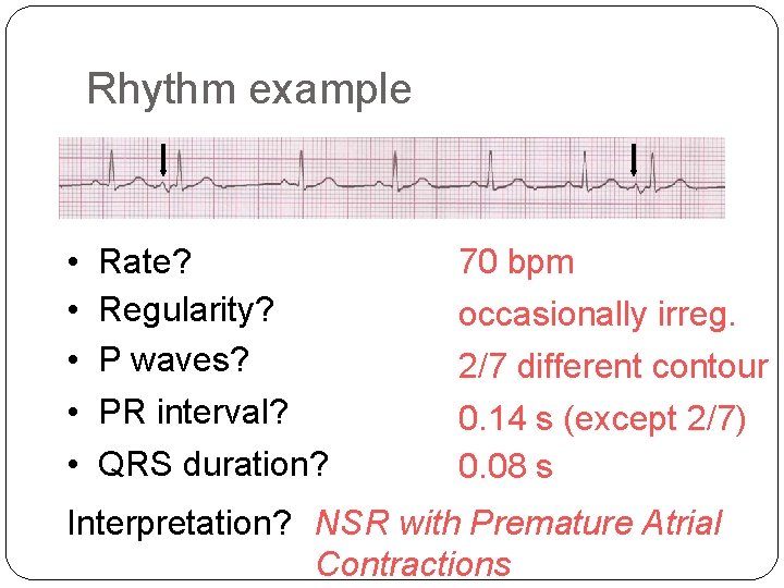 Rhythm example • • • Rate? Regularity? P waves? PR interval? QRS duration? 70 Rhythm example • • • Rate? Regularity? P waves? PR interval? QRS duration? 70