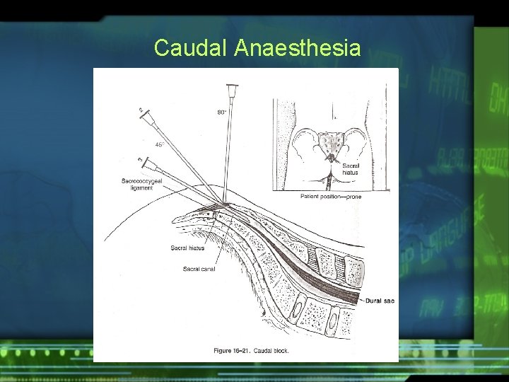 Caudal Anaesthesia 