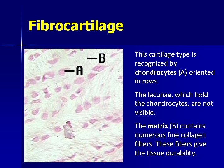 Fibrocartilage This cartilage type is recognized by chondrocytes (A) oriented in rows. The lacunae,