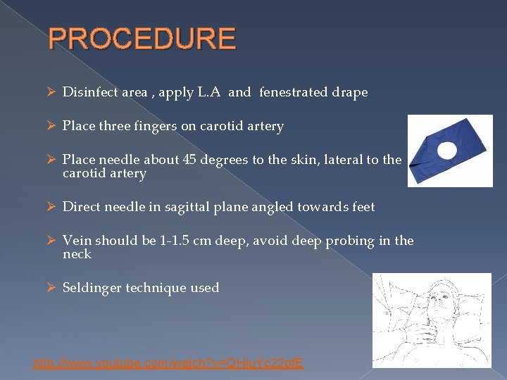 PROCEDURE Ø Disinfect area , apply L. A and fenestrated drape Ø Place three