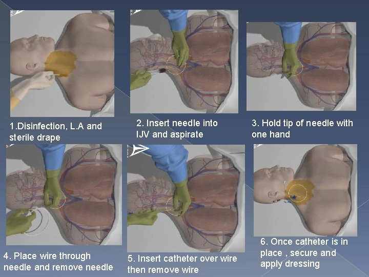 1. Disinfection, L. A and sterile drape 4. Place wire through needle and remove