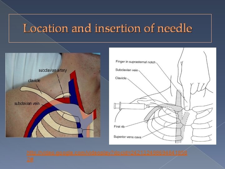 Location and insertion of needle http: //video. google. com/videoplay? docid=242132498694841858 2# 