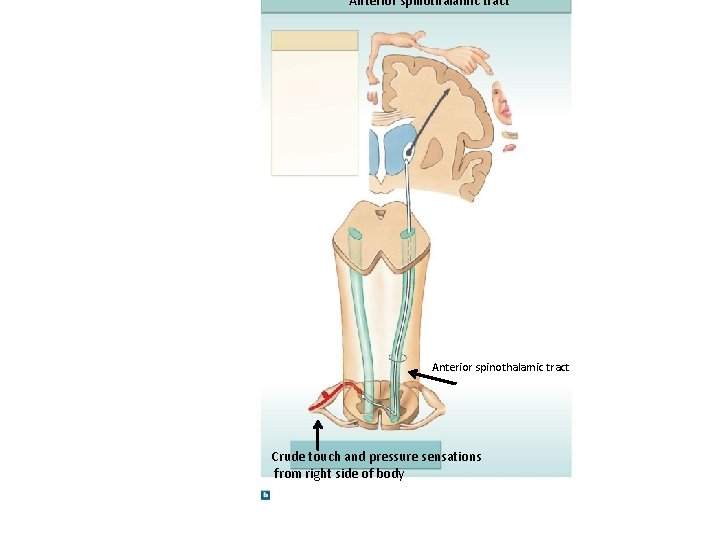 Anterior spinothalamic tract Crude touch and pressure sensations from right side of body 