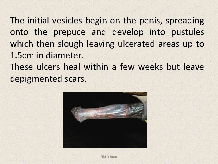 The initial vesicles begin on the penis, spreading onto the prepuce and develop into
