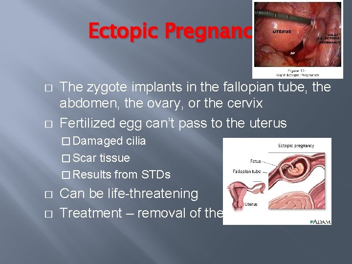 Ectopic Pregnancy � � The zygote implants in the fallopian tube, the abdomen, the