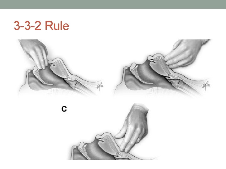 3 -3 -2 Rule 