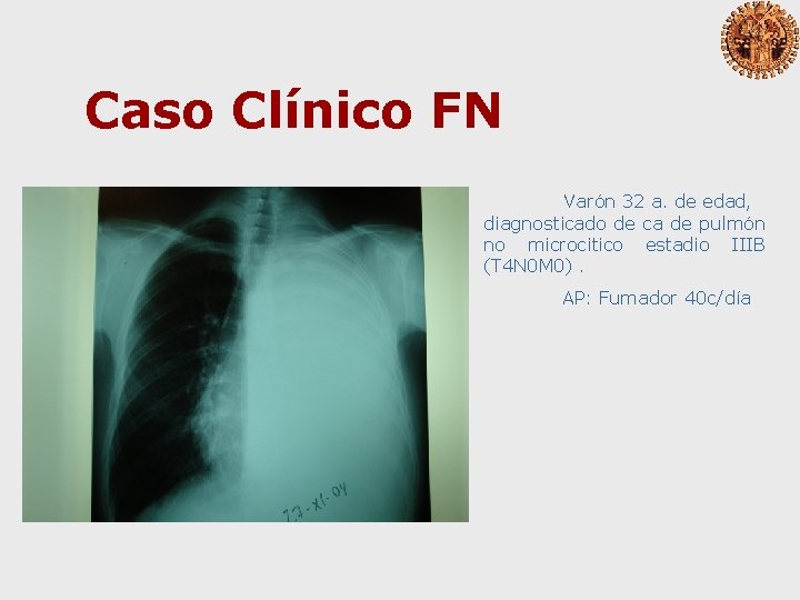 Caso Clínico FN Varón 32 a. de edad, diagnosticado de ca de pulmón no