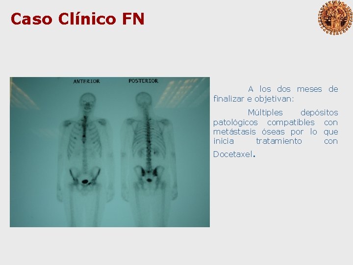 Caso Clínico FN A los dos meses de finalizar e objetivan: Múltiples depósitos patológicos