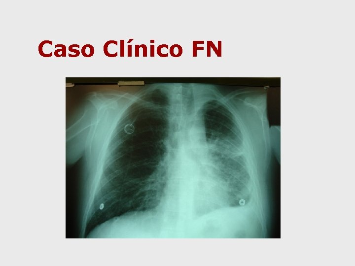 Caso Clínico FN 