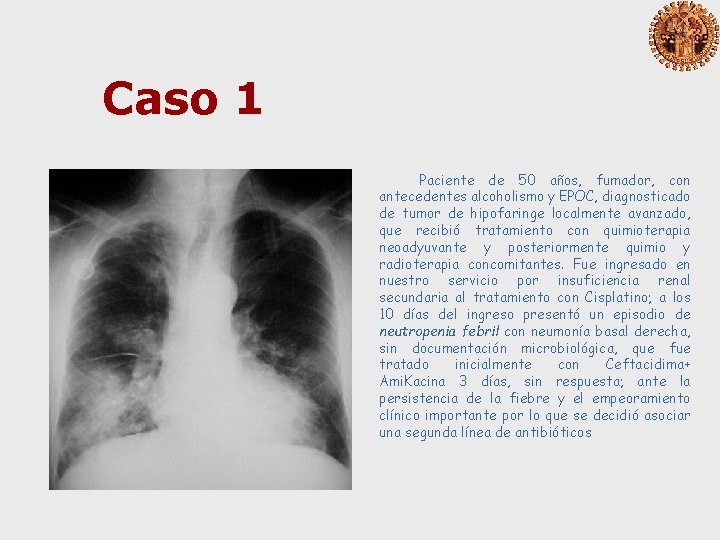 Caso 1 Paciente de 50 años, fumador, con antecedentes alcoholismo y EPOC, diagnosticado de