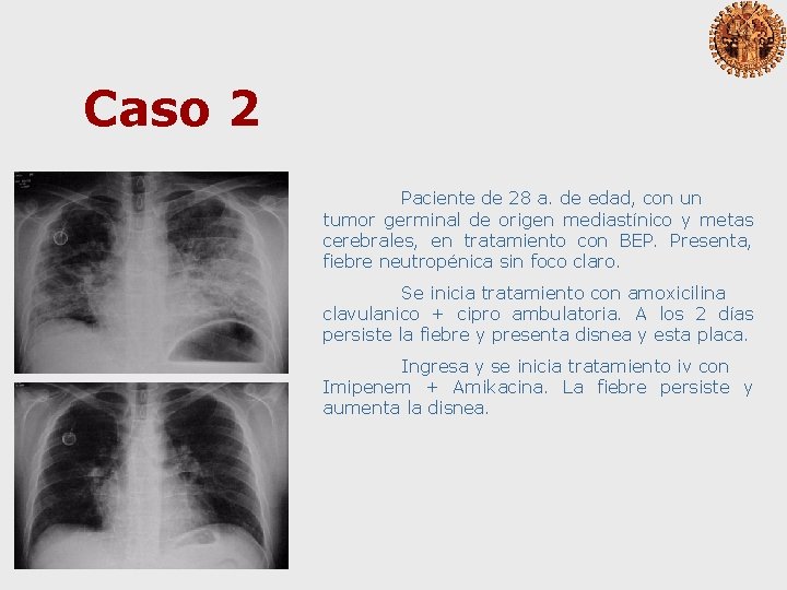 Caso 2 Paciente de 28 a. de edad, con un tumor germinal de origen