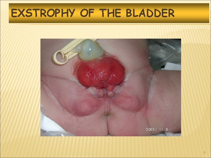 EXSTROPHY OF THE BLADDER 4 