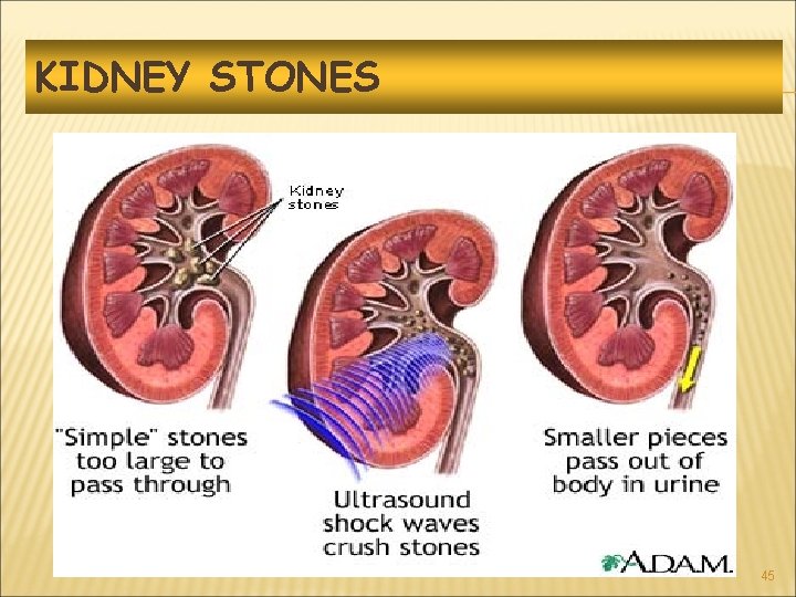 KIDNEY STONES 45 