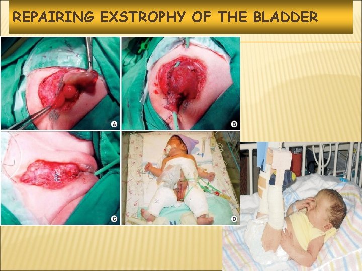 REPAIRING EXSTROPHY OF THE BLADDER 5 