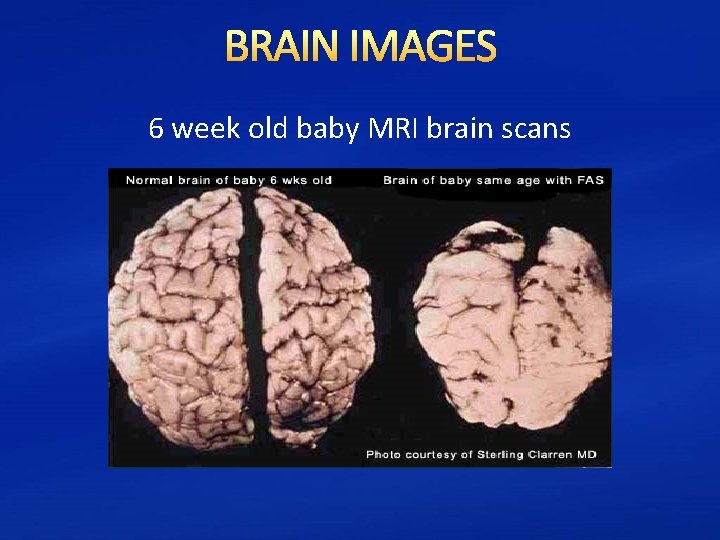 BRAIN IMAGES 6 week old baby MRI brain scans 