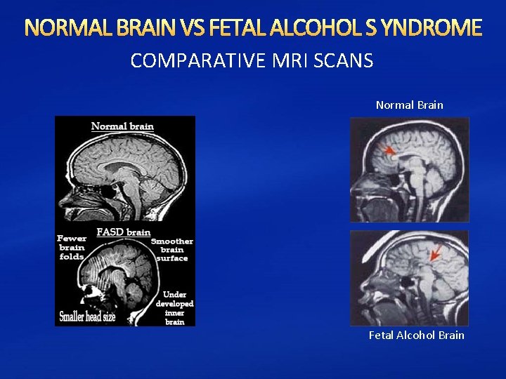 NORMAL BRAIN VS FETAL ALCOHOL S YNDROME COMPARATIVE MRI SCANS Normal Brain Fetal Alcohol