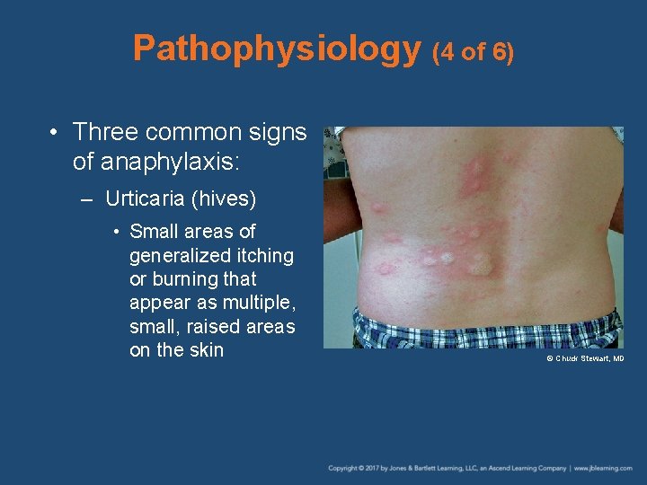 Pathophysiology (4 of 6) • Three common signs of anaphylaxis: – Urticaria (hives) •