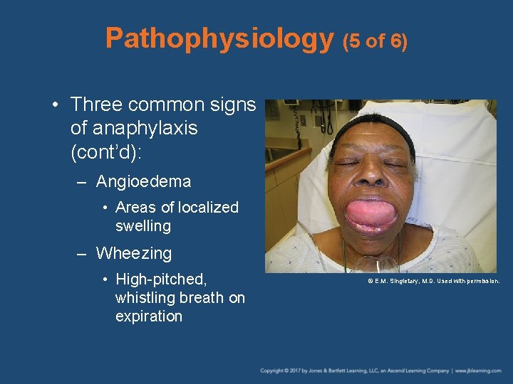 Pathophysiology (5 of 6) • Three common signs of anaphylaxis (cont’d): – Angioedema •