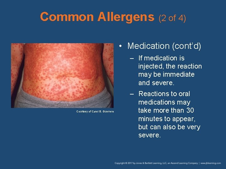 Common Allergens (2 of 4) • Medication (cont’d) – If medication is injected, the