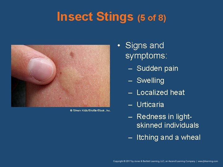 Insect Stings (5 of 8) • Signs and symptoms: – Sudden pain – Swelling