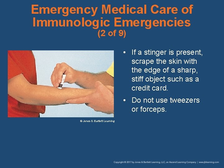 Emergency Medical Care of Immunologic Emergencies (2 of 9) • If a stinger is