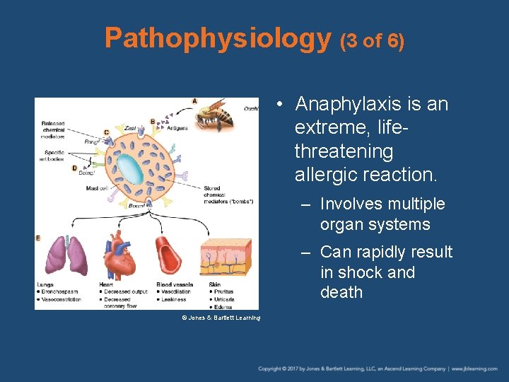 Pathophysiology (3 of 6) • Anaphylaxis is an extreme, lifethreatening allergic reaction. – Involves