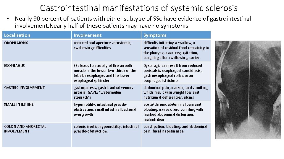 Gastrointestinal manifestations of systemic sclerosis • Nearly 90 percent of patients with either subtype Gastrointestinal manifestations of systemic sclerosis • Nearly 90 percent of patients with either subtype