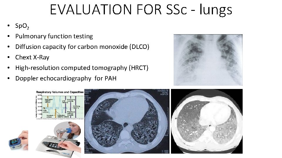 EVALUATION FOR SSc - lungs • • • Sp. O 2 Pulmonary function testing EVALUATION FOR SSc - lungs • • • Sp. O 2 Pulmonary function testing