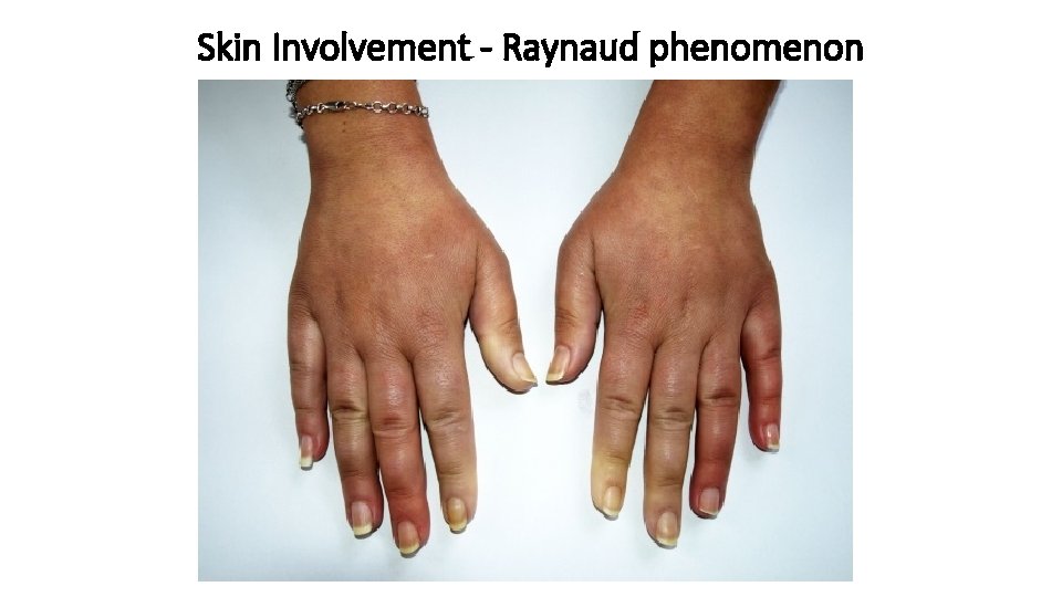 Skin Involvement - Raynaud phenomenon Skin Involvement - Raynaud phenomenon