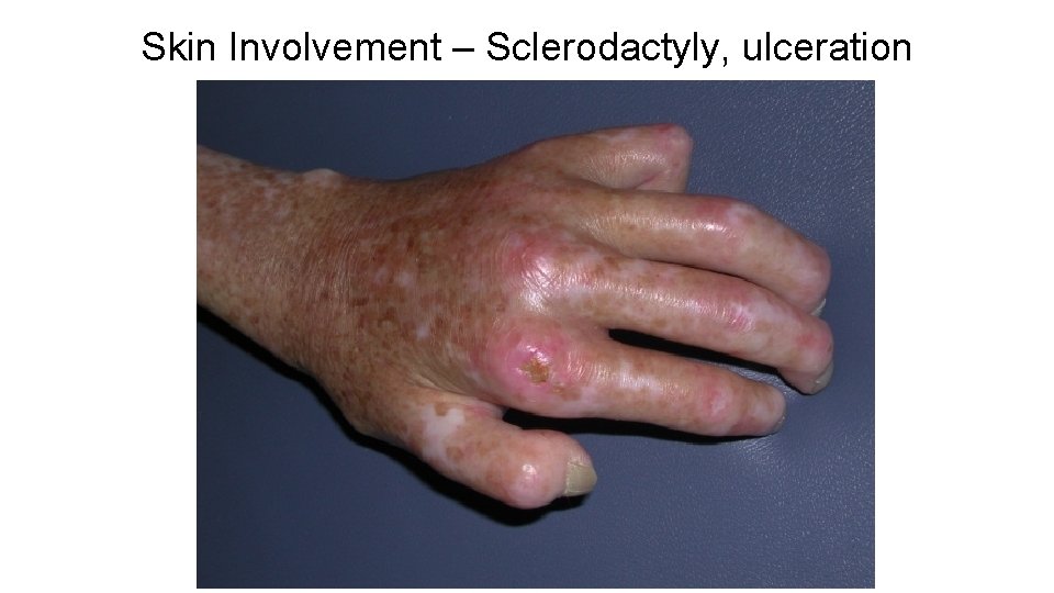Skin Involvement – Sclerodactyly, ulceration Skin Involvement – Sclerodactyly, ulceration