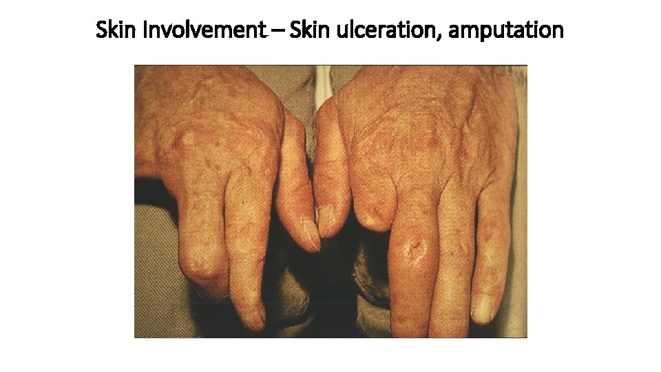 Skin Involvement – Skin ulceration, amputation Skin Involvement – Skin ulceration, amputation