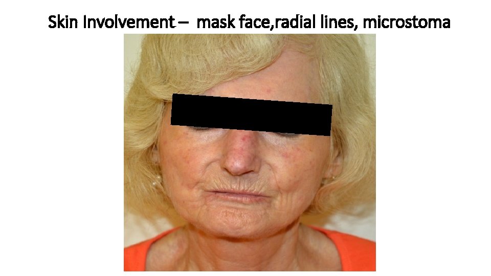 Skin Involvement – mask face, radial lines, microstoma Skin Involvement – mask face, radial lines, microstoma