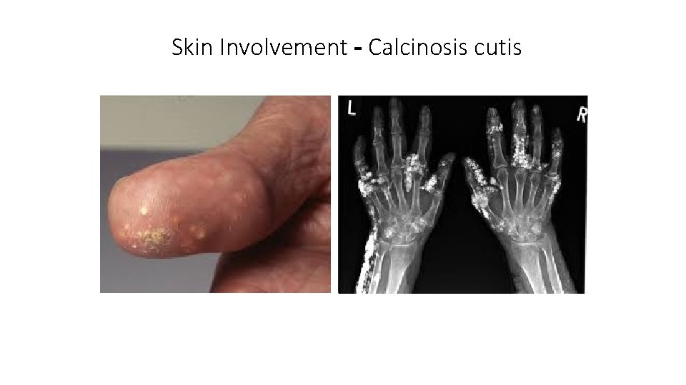 Skin Involvement - Calcinosis cutis Skin Involvement - Calcinosis cutis