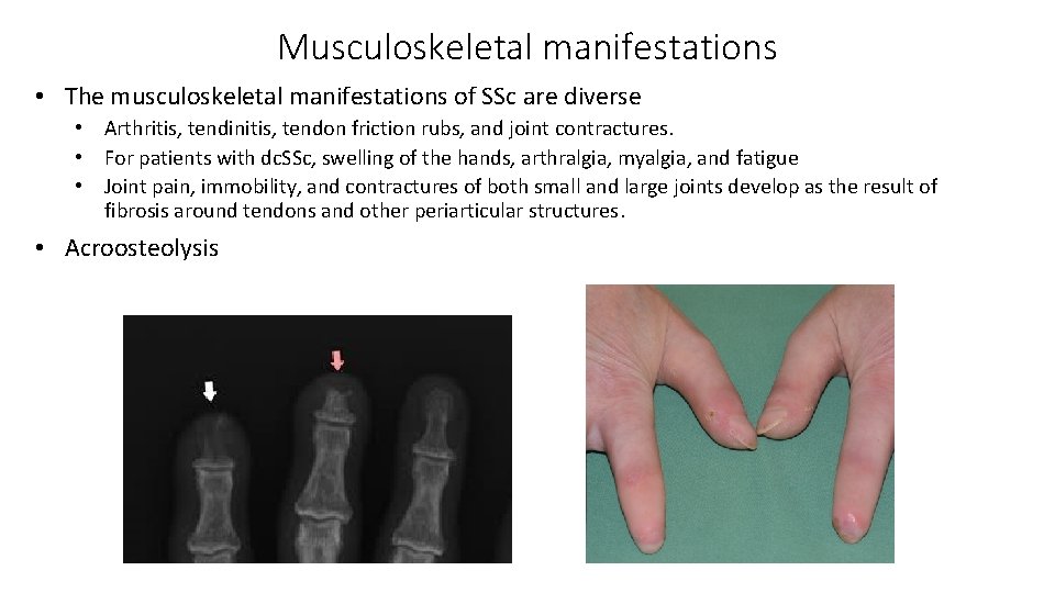 Musculoskeletal manifestations • The musculoskeletal manifestations of SSc are diverse • Arthritis, tendinitis, tendon Musculoskeletal manifestations • The musculoskeletal manifestations of SSc are diverse • Arthritis, tendinitis, tendon