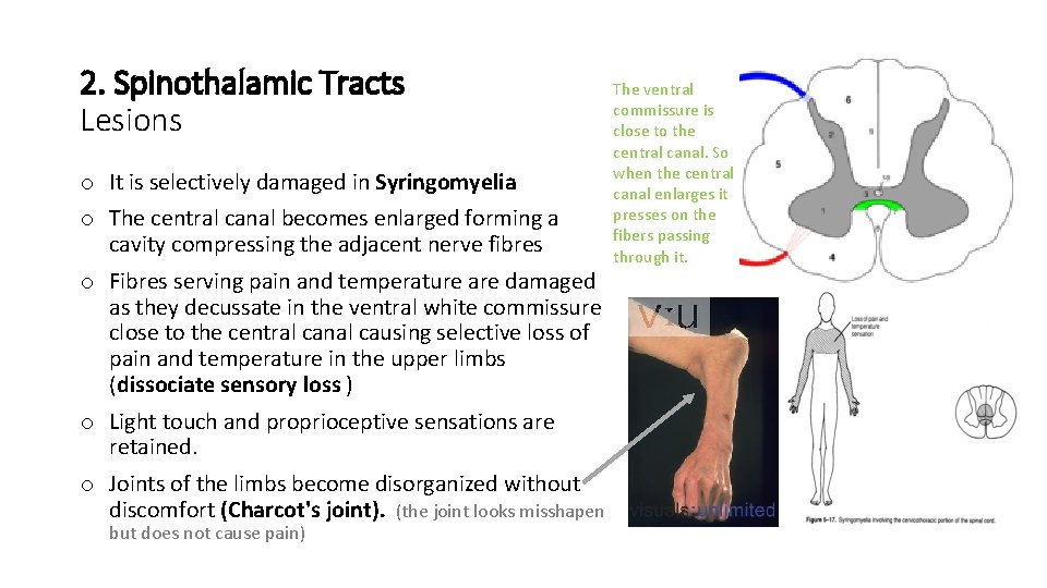 2. Spinothalamic Tracts Lesions o It is selectively damaged in Syringomyelia o The central