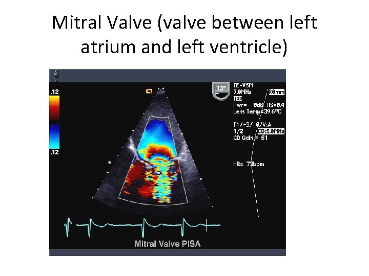 Mitral Valve (valve between left atrium and left ventricle) 