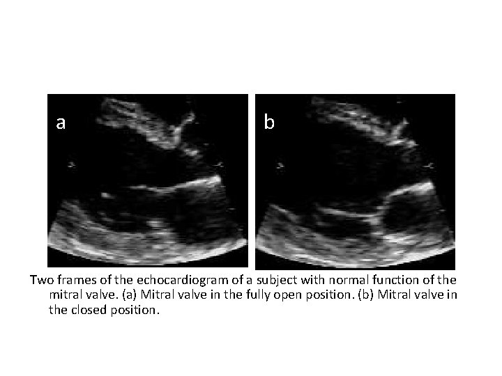 a b Two frames of the echocardiogram of a subject with normal function of