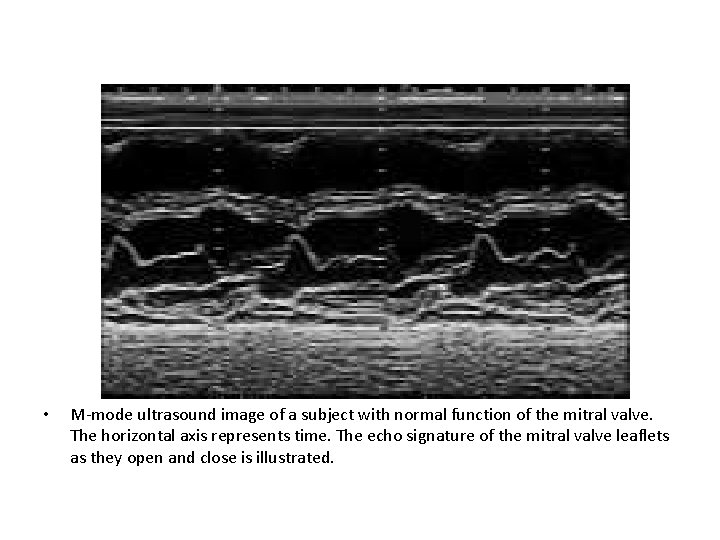  • M-mode ultrasound image of a subject with normal function of the mitral