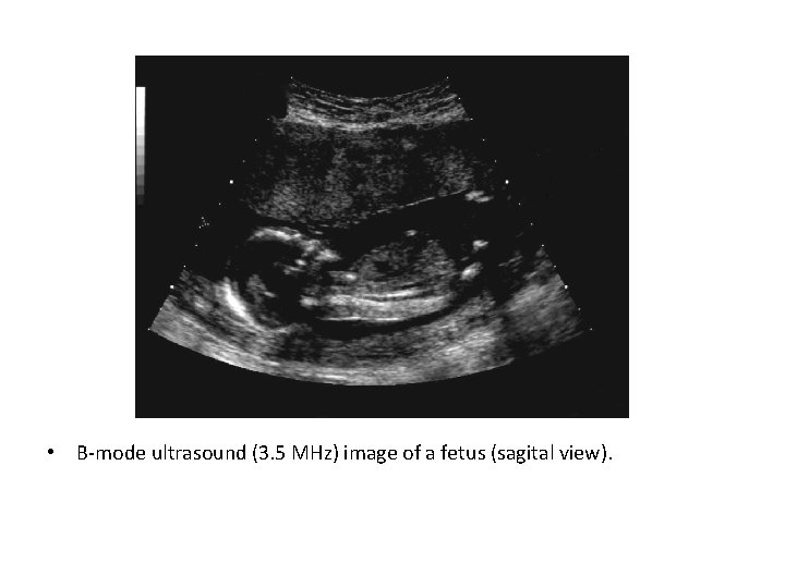  • B-mode ultrasound (3. 5 MHz) image of a fetus (sagital view). 