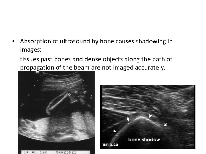 • Absorption of ultrasound by bone causes shadowing in images: tissues past bones