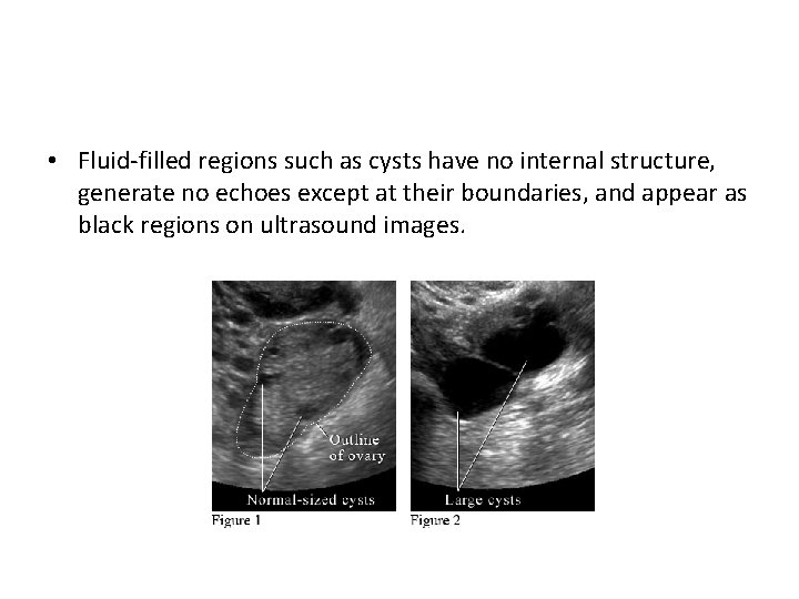  • Fluid-filled regions such as cysts have no internal structure, generate no echoes