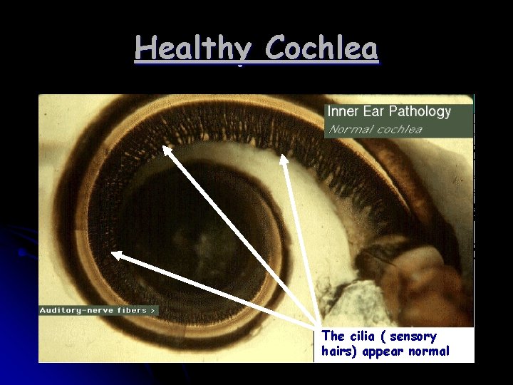 Healthy Cochlea The cilia ( sensory hairs) appear normal 