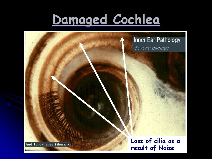 Damaged Cochlea Loss of cilia as a result of Noise 