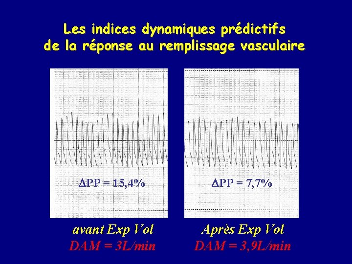 Les indices dynamiques prédictifs de la réponse au remplissage vasculaire PP = 15, 4%