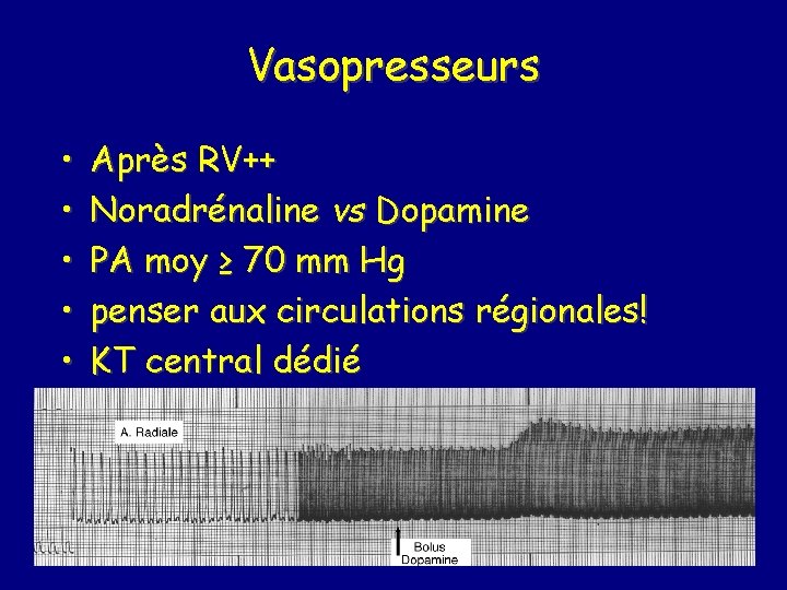 Vasopresseurs • • • Après RV++ Noradrénaline vs Dopamine PA moy ≥ 70 mm