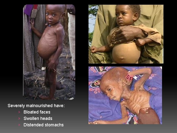 Severely malnourished have: › Bloated faces › Swollen heads › Distended stomachs 