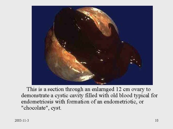 This is a section through an enlarnged 12 cm ovary to demonstrate a cystic